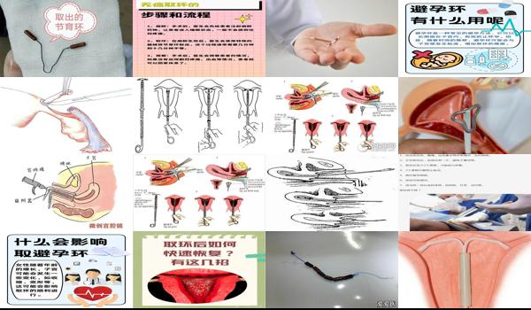 汕头取环去哪个医院好 - 汕头如何取环